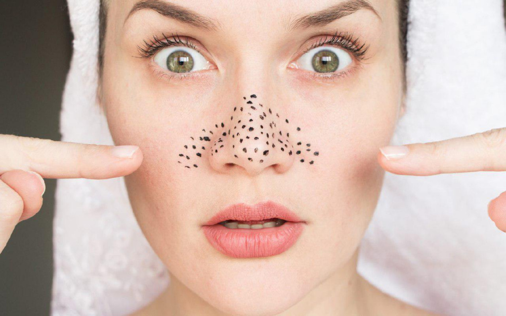 get rid of your blackheads